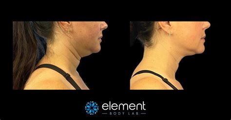 coolsculpting results timeline|CoolSculpting: How Long Do the Effect.